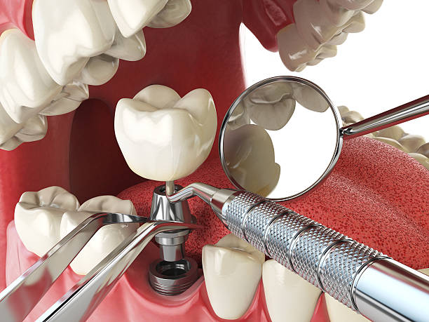 Best Emergency Root Canal Treatment in Lowell, MA